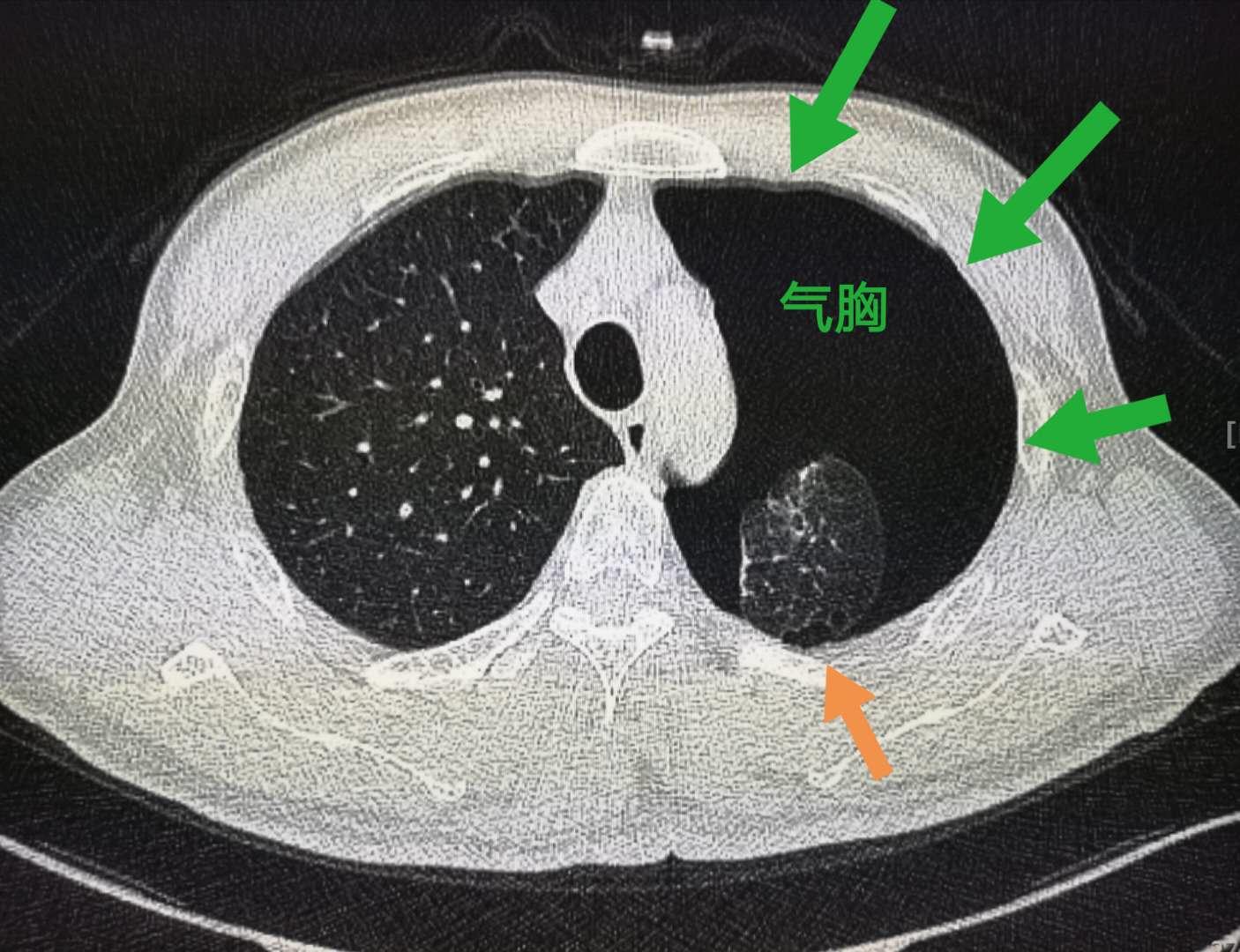 打个喷嚏结果鼻血流出来,打个喷嚏吐出一口血怎么回事