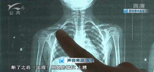 娃被撞多处骨折,孩子出车祸颅内多处骨折