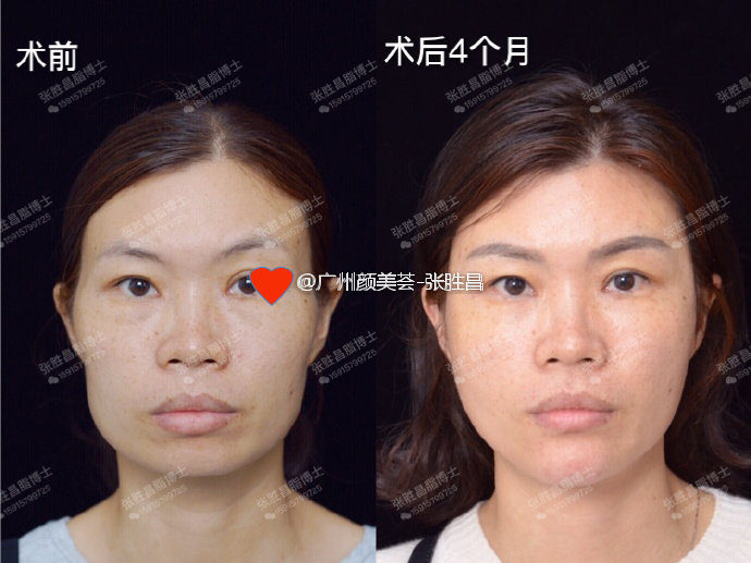 打完瘦脸针怎样快速分解肉毒素,打瘦脸针肉毒素的扩散范围是多少