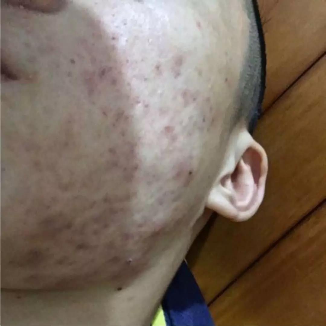 如何快速祛痘去痘印小妙招,怎样可以祛痘痘和痘印最有效