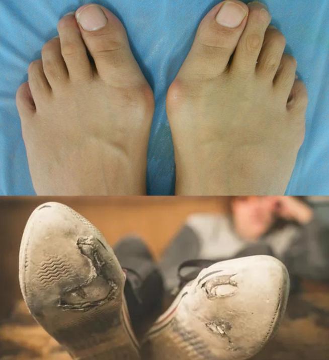 双脚外侧鞋底磨损严重,双脚鞋底磨损程度不同