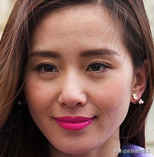 水光针怎么使皮肤好,水光针为您祛除肤质困扰