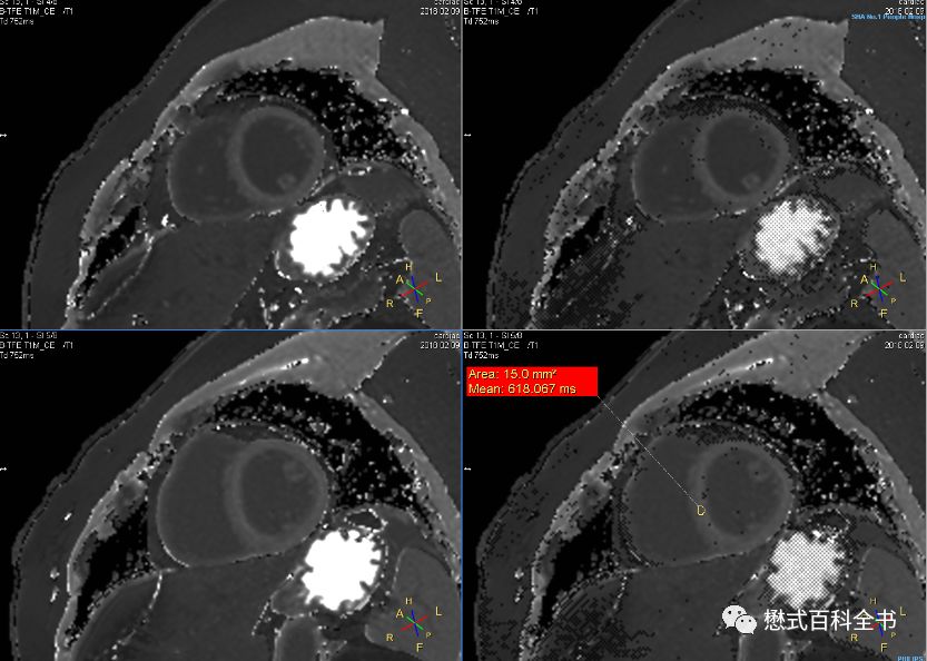 心脏磁共振定位方法,心脏磁共振各参数分析