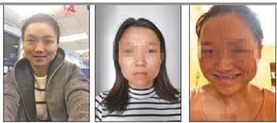 女子打瘦脸针成面瘫向院方索赔,女子瘦脸针打完毁容