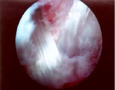 膝关节软骨移植手术风险大吗,膝关节软骨移植手术后多久能康复