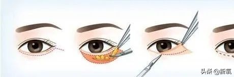 关晓彤怎样去泪沟,关晓彤眼袋去除视频