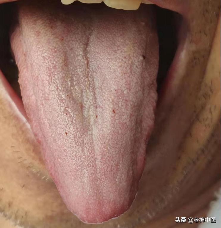 幽门螺旋杆菌胃炎正确的用药方式,幽门螺杆菌萎缩性胃炎的经方治疗