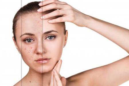 女生额头长痘痘是什么原因,女生额头长痘痘是什么征兆