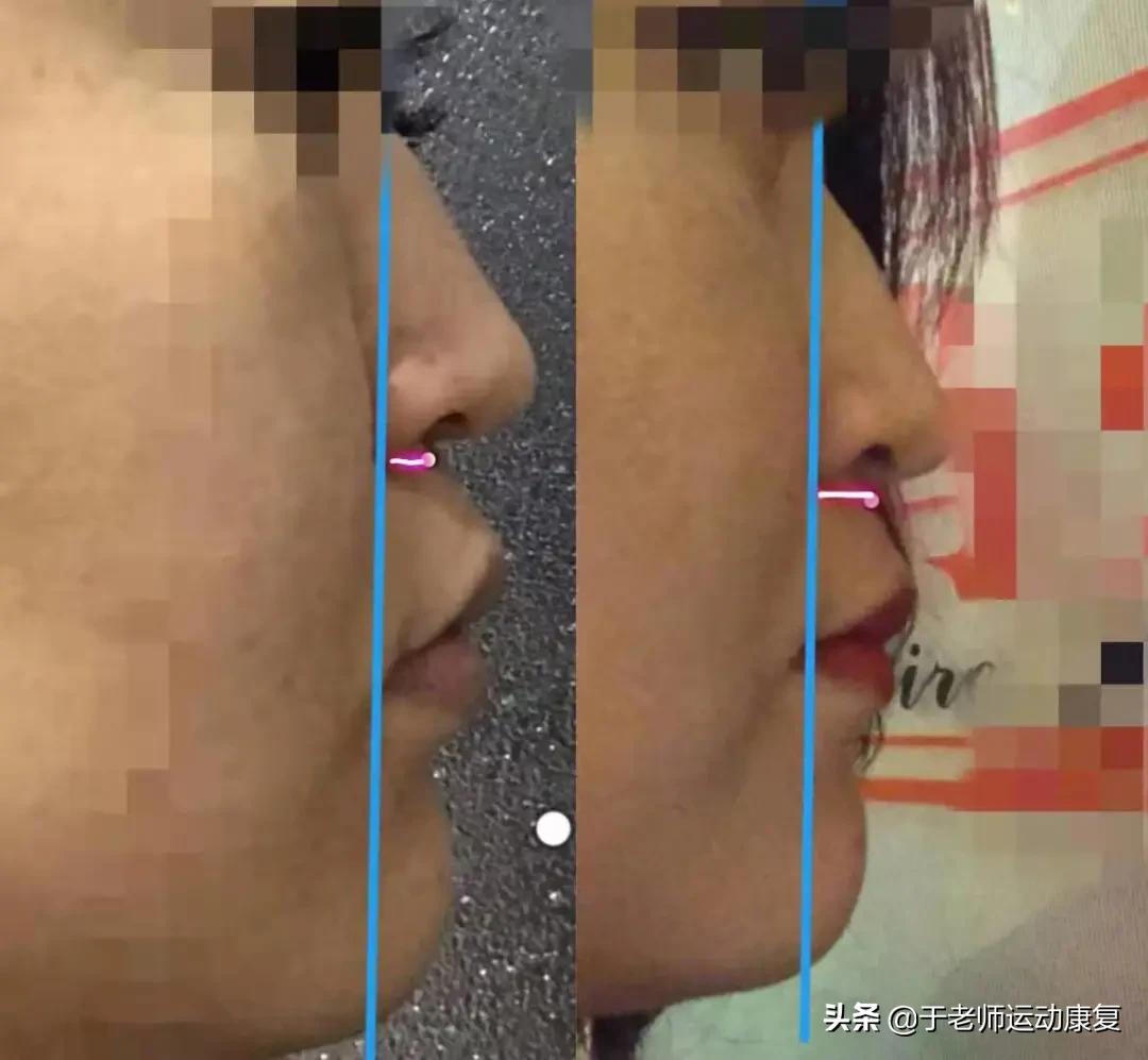 抗皱纹的有效方法,二十多岁脸上就有法令纹了怎么办