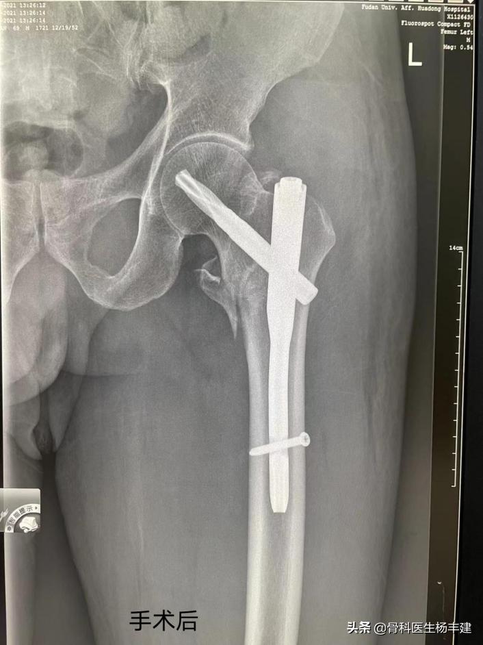 老人摔骨折多长时间能正常走路,老人摔倒哪种骨折最可怕