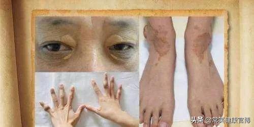 得了高胆固醇血症怎么办,高胆固醇血症有五个表现症状