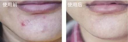 抗痘抑菌凝胶,祥顺比尔霍夫抑菌凝胶治理皮癣