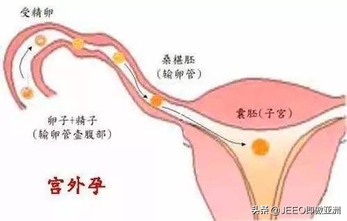 告诉你不知道的上环常识,关于上环的那些事科普
