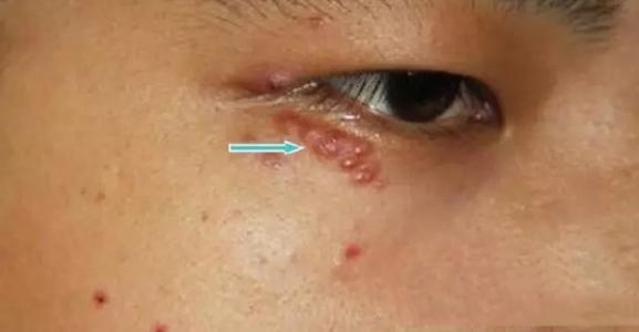 头螨脱发与脂溢性皮炎脱发的区别,脂溢性脱发是脂溢性皮炎引起的吗