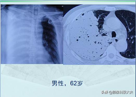 新冠肺炎对癌症有影响吗,癌症晚期肺炎怎么治疗