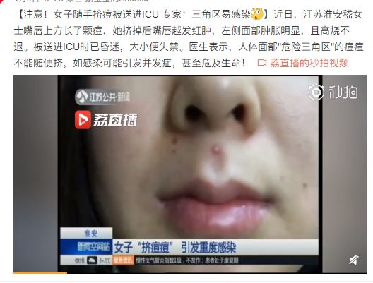 挤痘进了ICU，连下两次病危通知？这痘痘到底还能不能挤！
