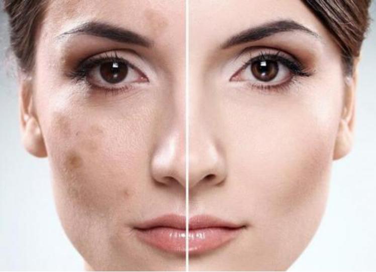 皮肤长斑长痘毛孔粗大的原因,皮肤毛孔粗大什么原因导致的