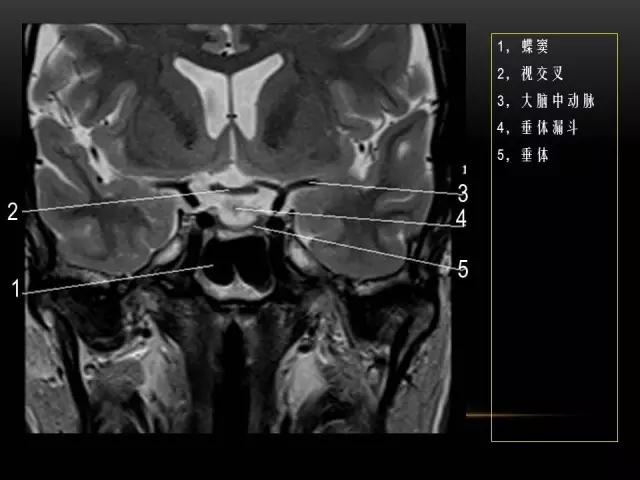 鼻腔鼻窦及颅底ct影像解剖,鼻窦解剖mri