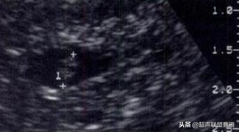 内见卵黄囊,卵黄囊肿瘤