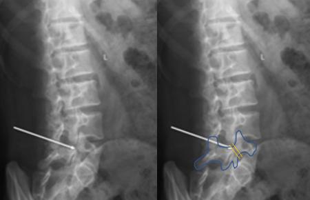 小孩会腰痛是怎么回事,小孩腰椎滑脱能恢复吗