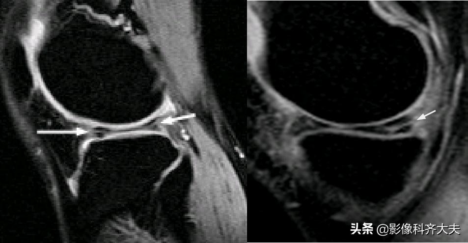 膝关节半月板损伤的磁共振,膝关节半月板病变的mri诊断与鉴别