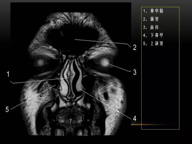 鼻腔鼻窦及颅底ct影像解剖,鼻窦解剖mri