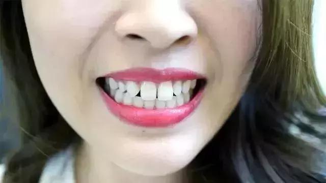 怎么才能真正有效的美白牙齿,最快最有效美白牙齿的方法