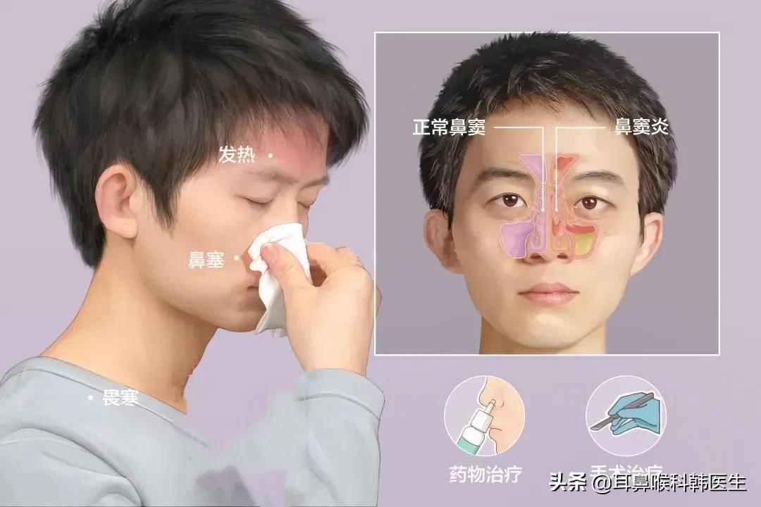 鼻炎鼻窦炎有什么区别科普,为什么鼻腔炎症易引起鼻窦炎