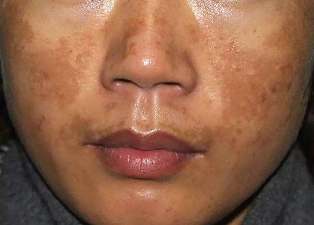 褐斑能自己消除吗,褐青色斑20年了还能治疗吗