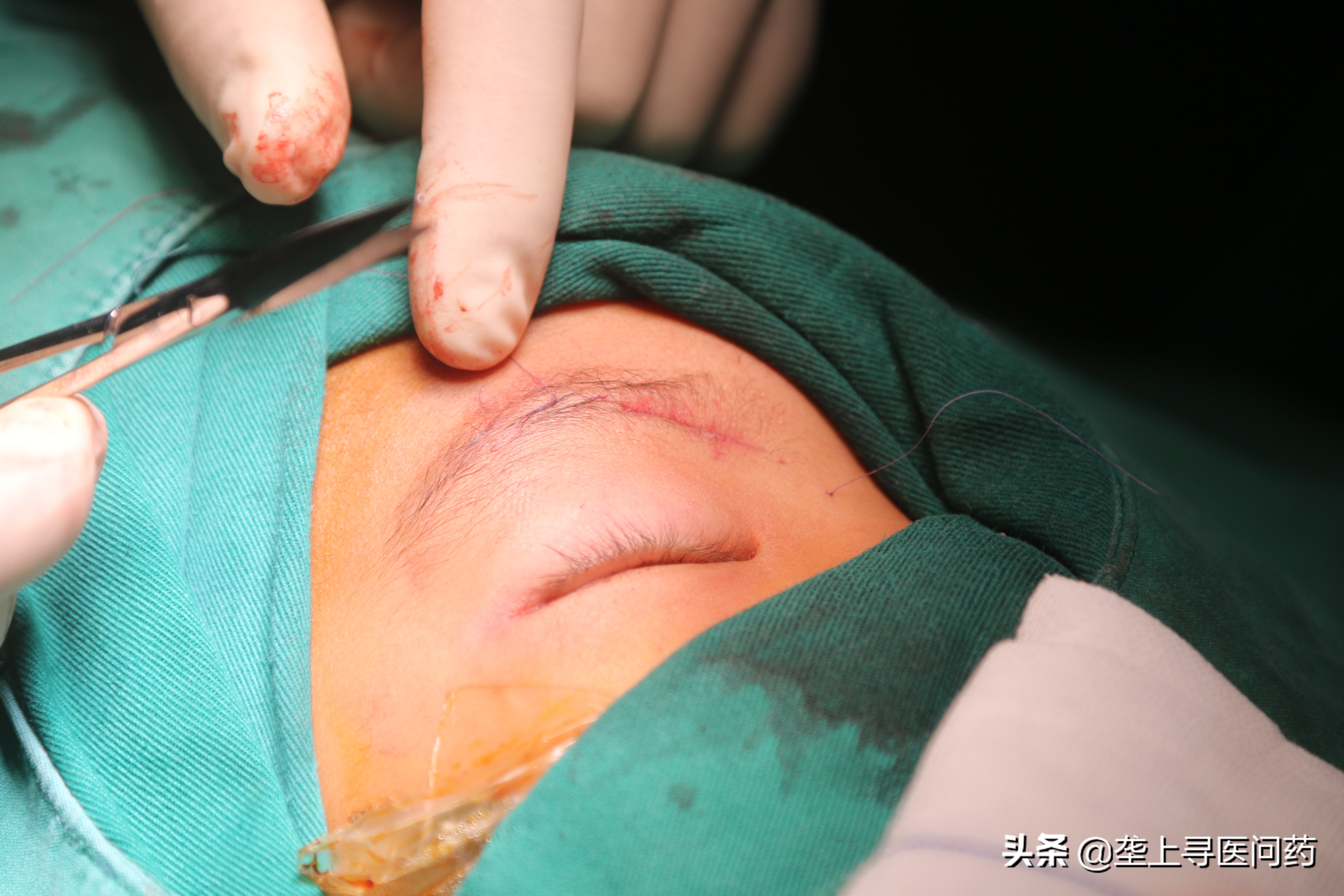 小孩眼睛长了良性肿瘤,孩子眼睛突然斜视会是大脑肿瘤吗