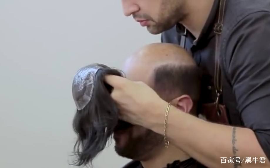 日本对秃头有什么样的治疗,让人秃头的十个方法