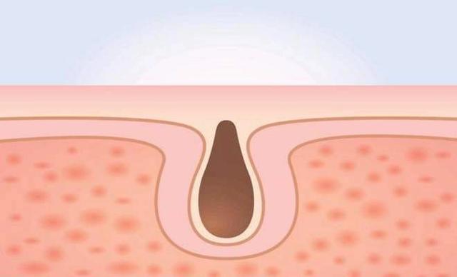 脸上毛孔粗大为什么不可逆,鼻子上的毛孔粗大不可逆