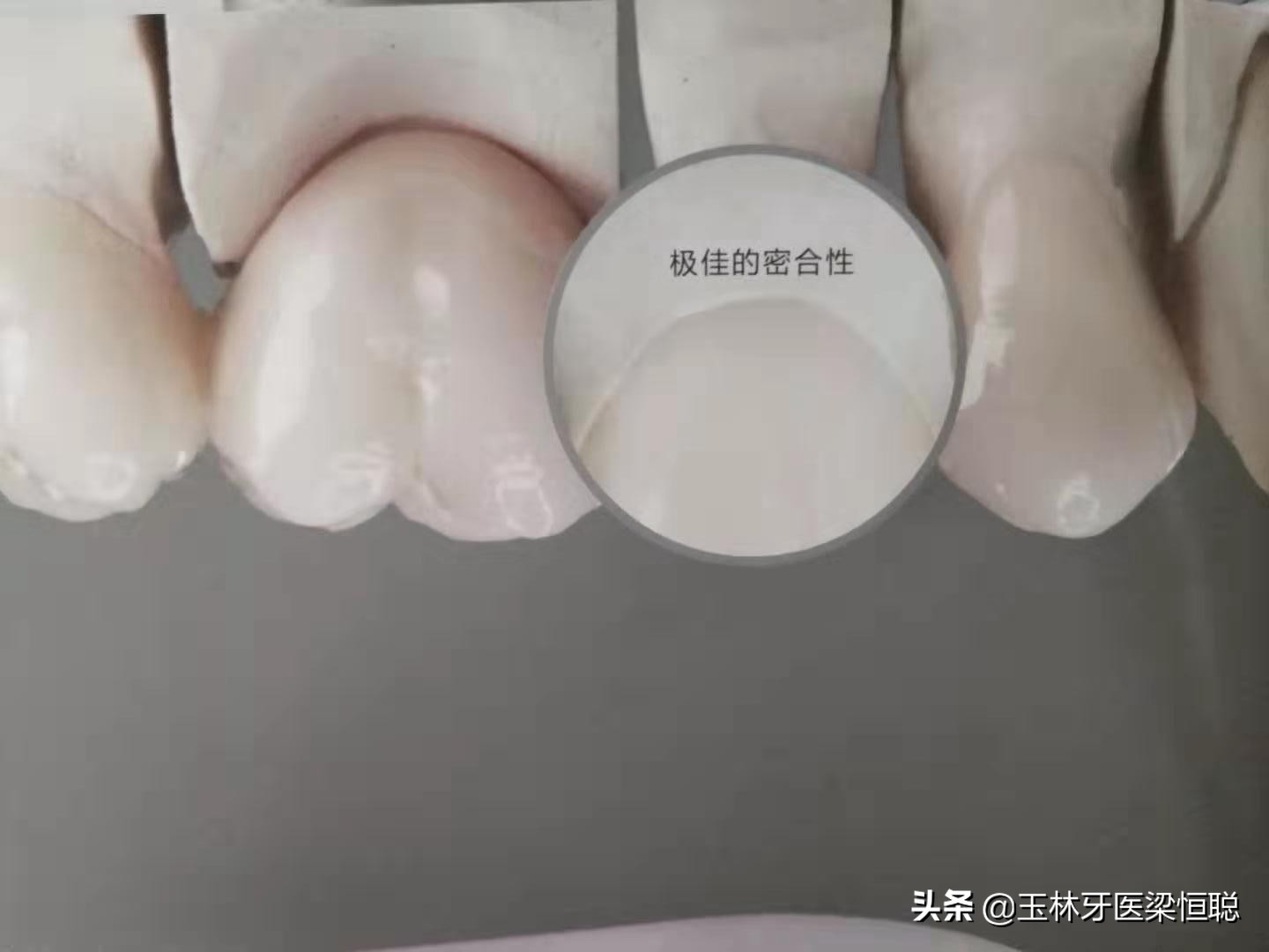 全瓷牙和烤瓷牙冠的区别,烤瓷牙和全瓷牙冠有什么区别