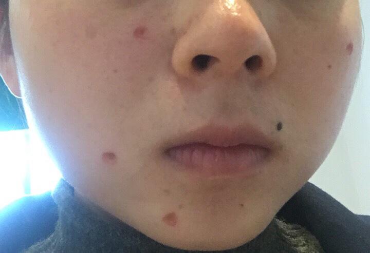 药水点痣和激光祛痣有什么区别,祛痣用激光还是药水效果好点