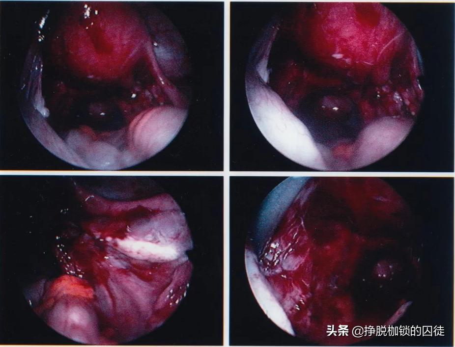 痛经女*福性**音？“液体活检”技术可以快速诊断子宫内膜异位症？