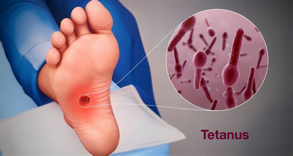 外伤后破伤风针具体指什么,受伤后什么时间注射破伤风针有效