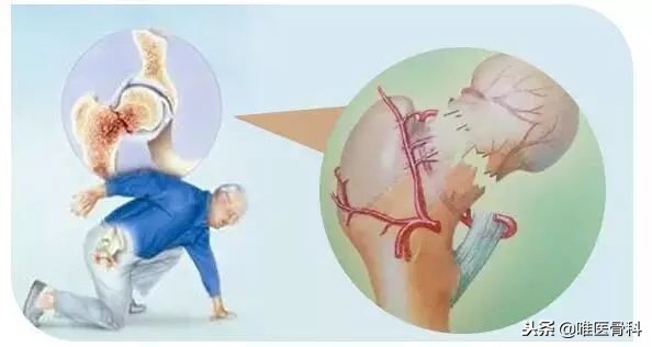 老年人螺旋形骨折多久能康复,股骨骨折是老人最后一次骨折