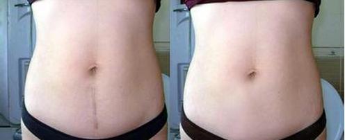 月薪四万月嫂总结：超全产后伤口护理指南，顺产、剖腹产全包含