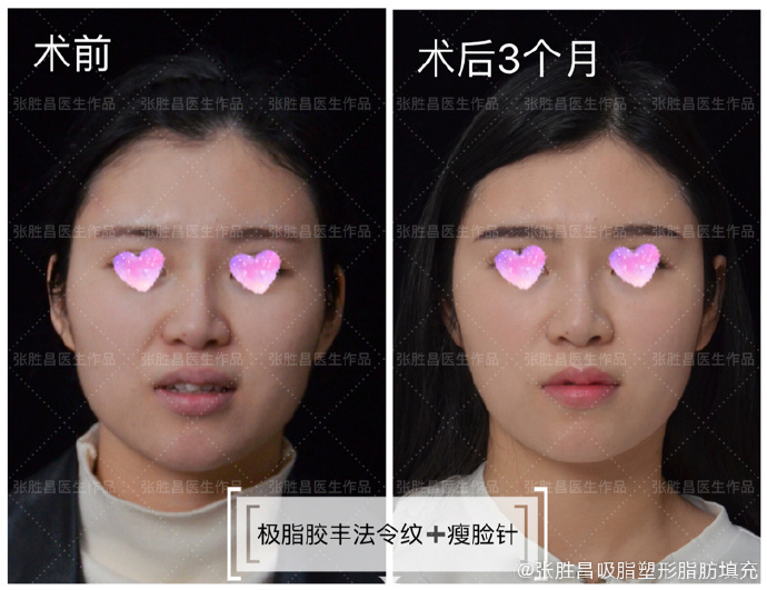 打完瘦脸针怎样快速分解肉毒素,打瘦脸针肉毒素的扩散范围是多少