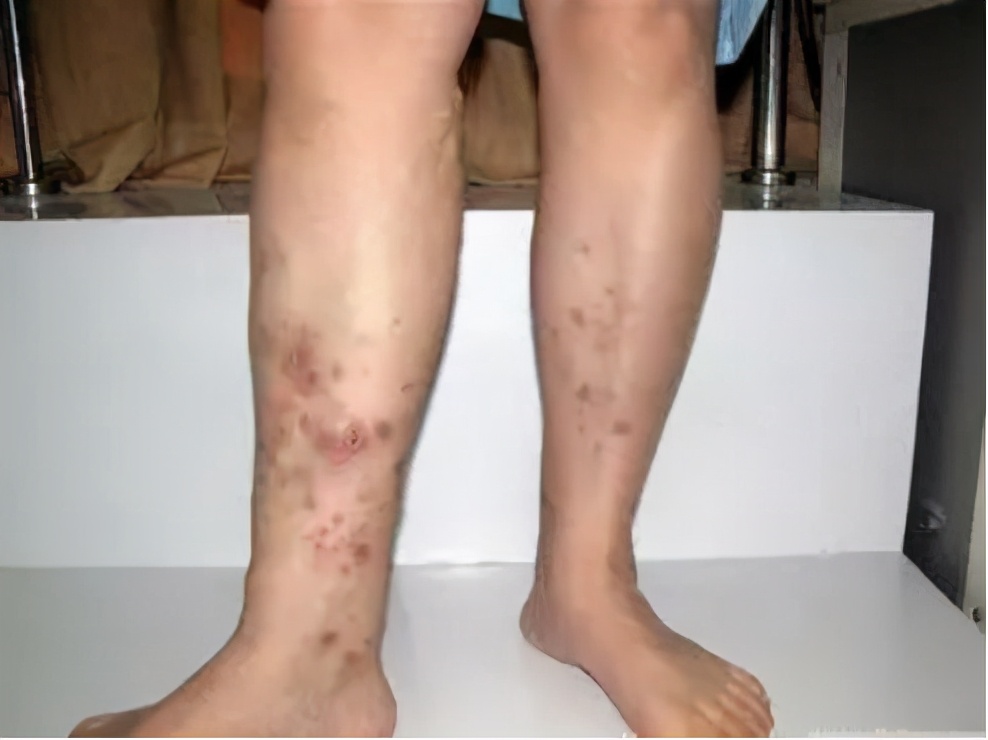 血管外科静脉曲张治疗,静脉曲张引起血管瘤如何治疗