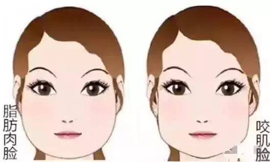 打瘦脸针脸会肿吗,瘦脸针值不值得打