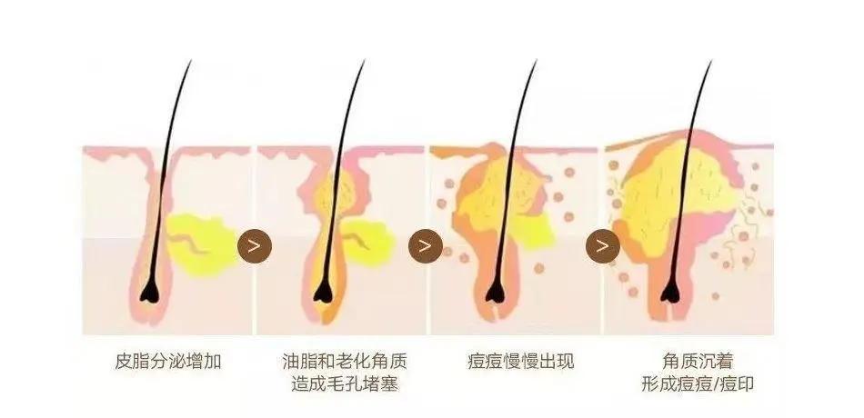 丘疹性痤疮是什么,30岁丘疹性痤疮