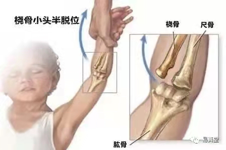 小儿桡骨小头半脱位图,桡骨小头半脱位复位最佳时间