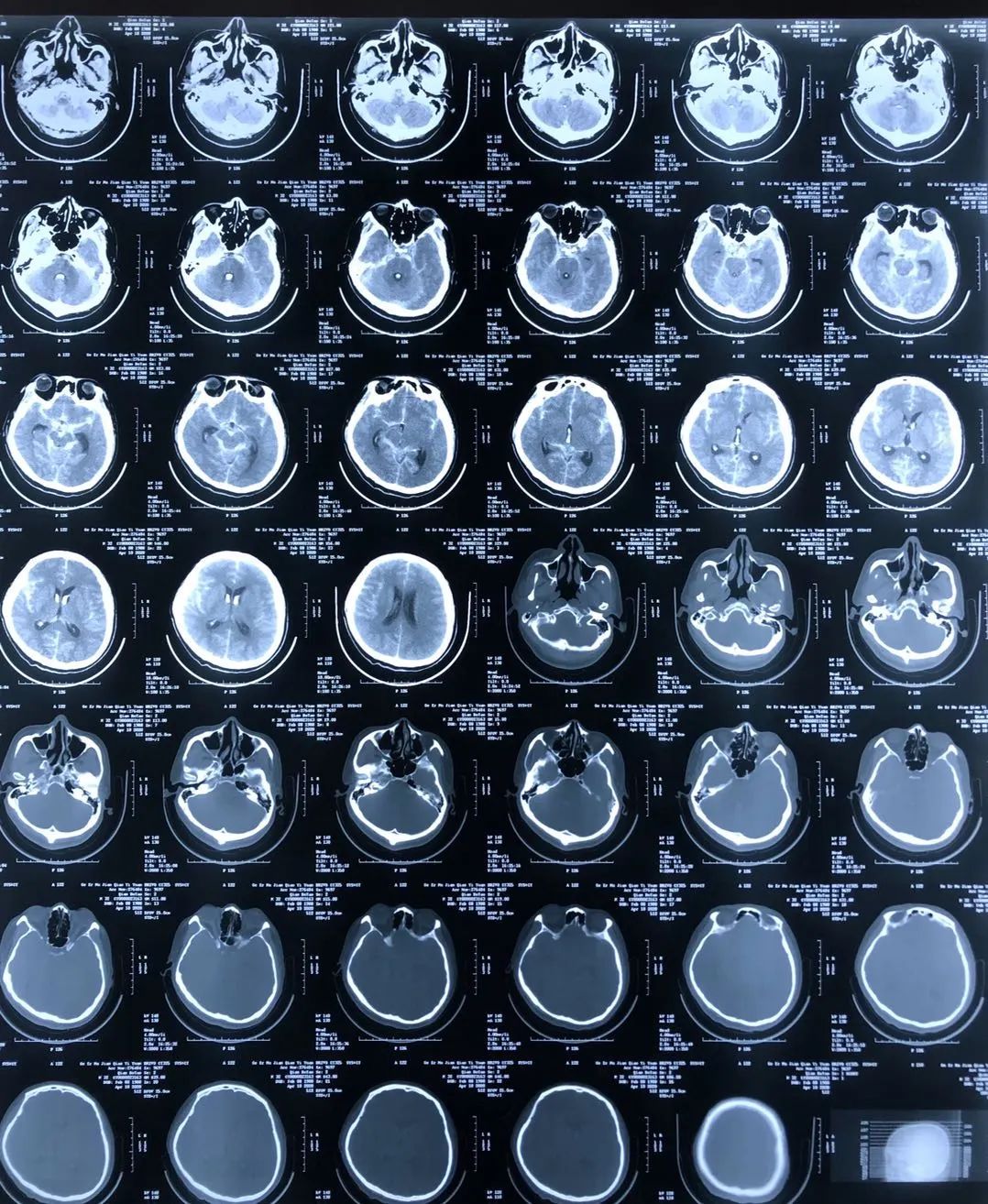 来自空中的救援-动脉瘤治疗一例