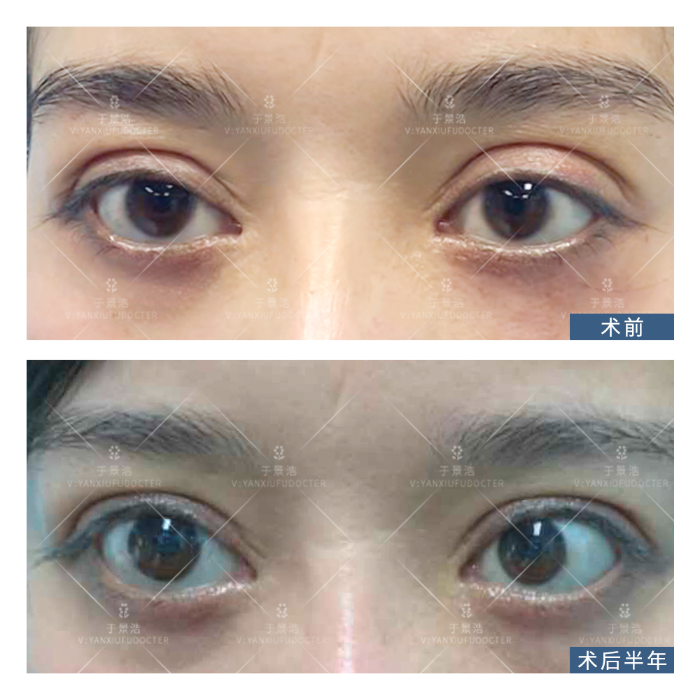 双眼皮修复为什么更贵,双眼皮修复是怎么做的