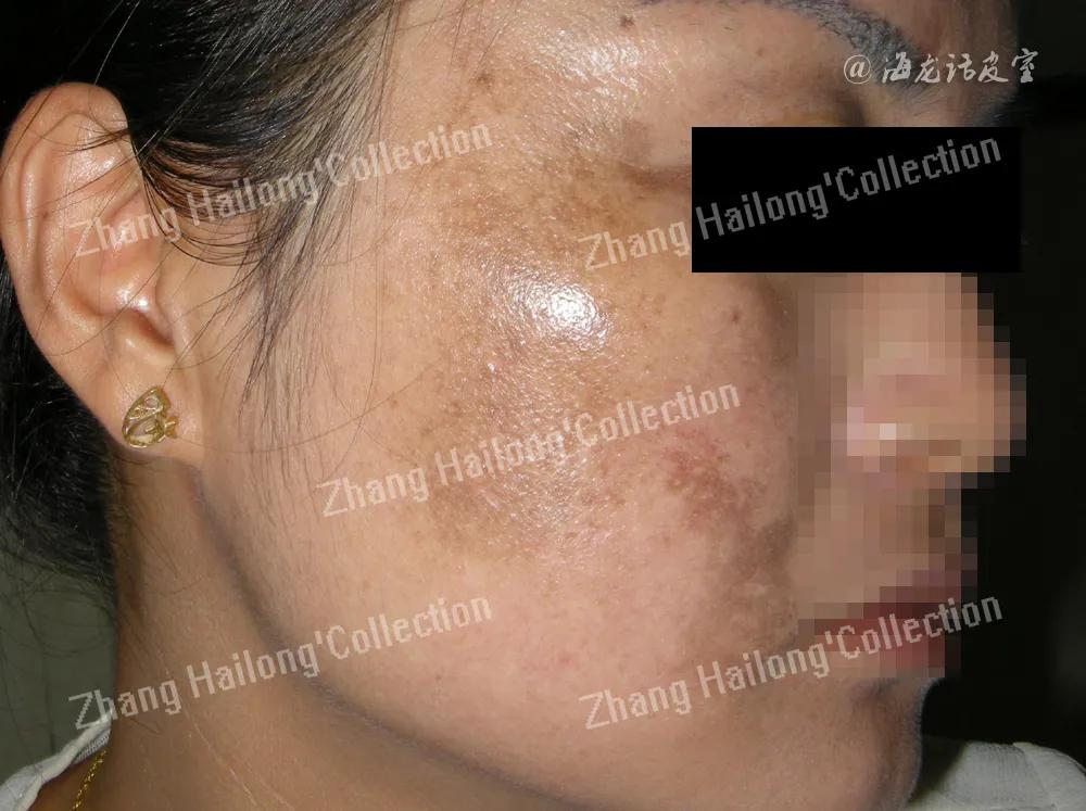 褐斑吃什么药能根除,除褐斑的办法