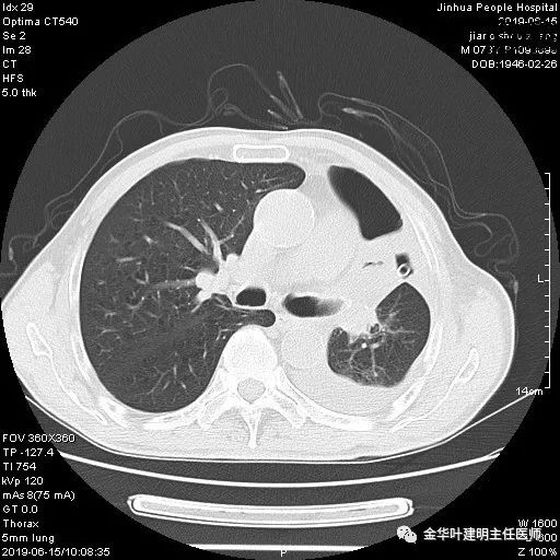 手术引起乳糜胸,有没有做了肺结节手术后是误诊的