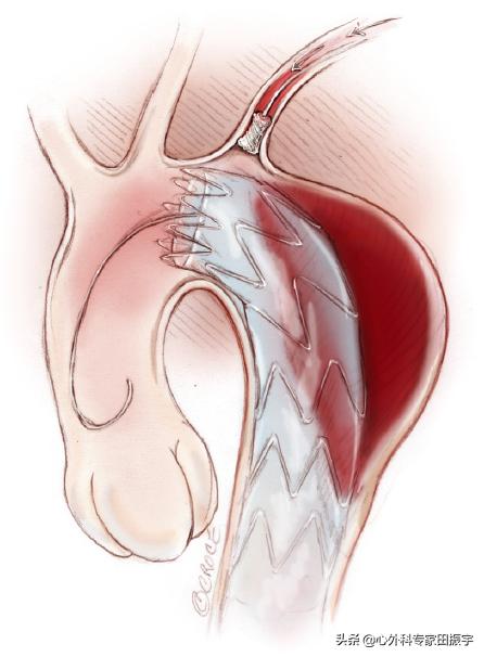 主动脉夹层破裂的院前急救,主动脉夹层破裂的临床表现和处理