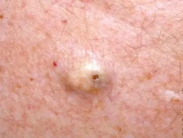 扁平疣和黑色素痣区别,疣与色素痣的区别