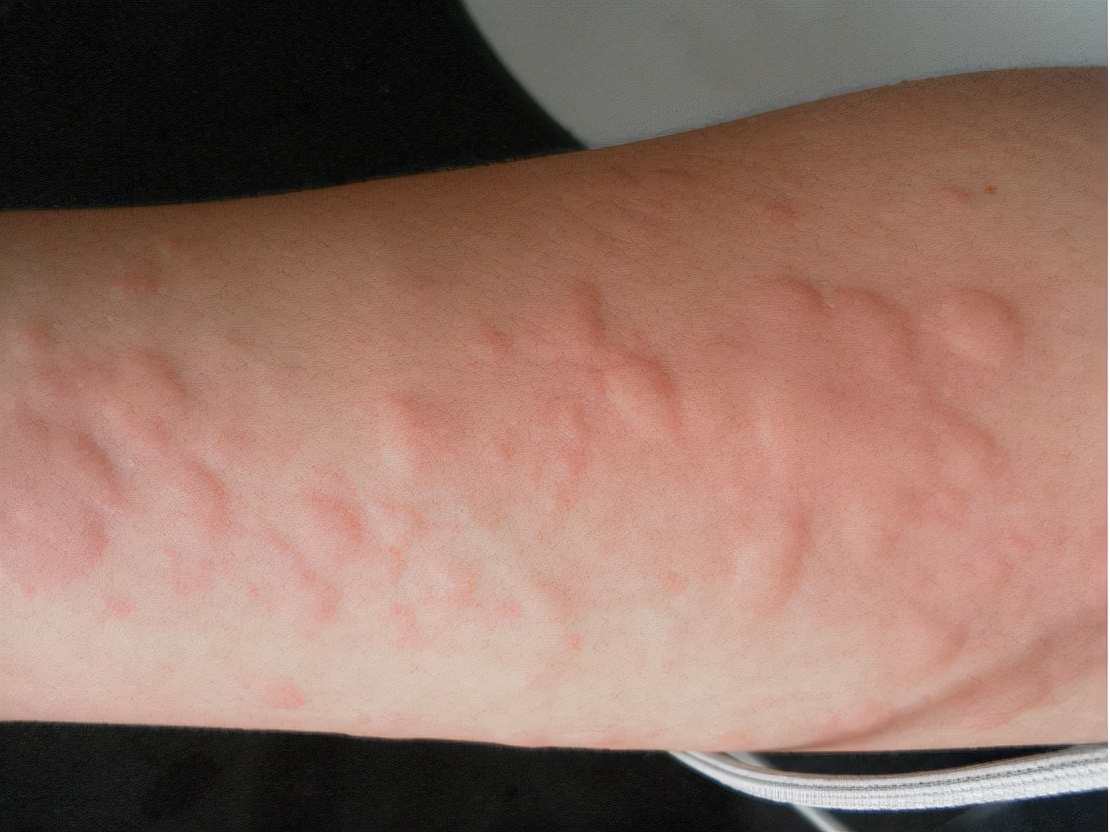 荨麻疹缓解瘙痒的方法是什么,荨麻疹瘙痒难忍可以用什么缓解